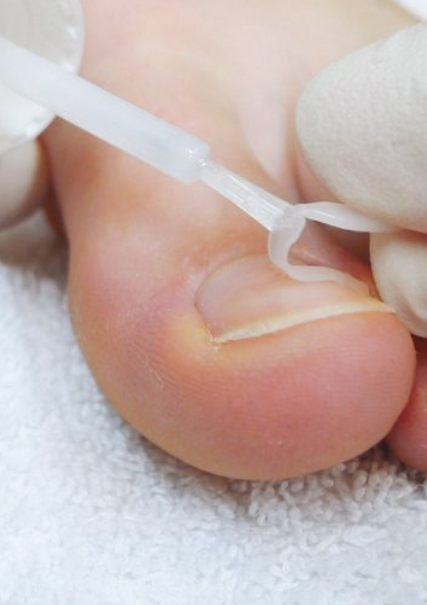 Nagelspangen-Therapie